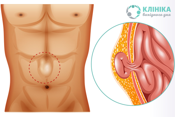 Паховая грыжа у мужчин: причины, симптомы и лечение, профилактика