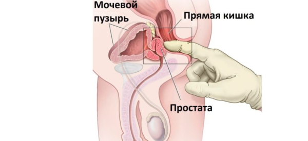 Массаж простаты для потенции и эрекции мужчин: как делать