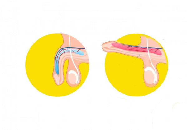 Проблемы с потенцией в 20-летнем возрасте &ndash; почему и что делать