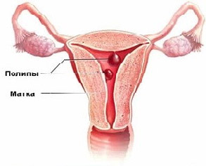 Папилломы на шейке матки: лечение народными средствами