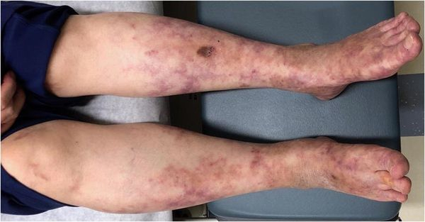 Узелковый периартериит: понятие, причины, течение, диагностика, лечение