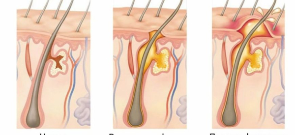 Как устранить отек после фурункула?