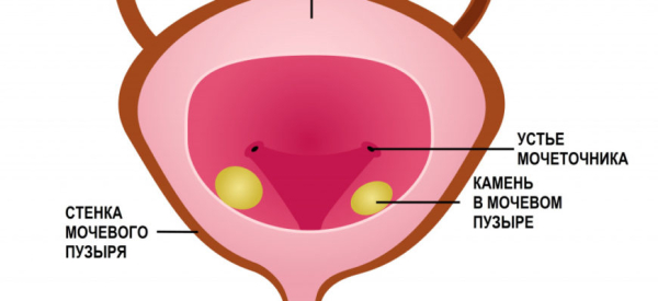 Уретрит у ребенка: чем лечить, симптомы