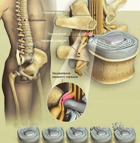 Остеохондроз и потенция: влияние заболевания на мужскую силу
