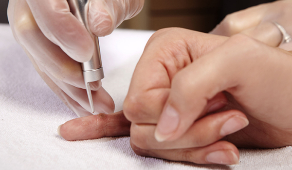 Удаление бородавки жидким азотом: последствия процедуры