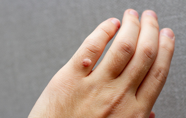 Причины, симптомы и лечение бородавок на лице