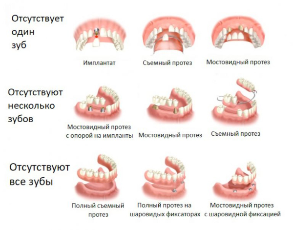 Классификация методик протезирования зубов и выбор лучшего зубного протеза