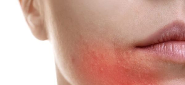 Способы лечения периорального дерматита у взрослых и детей