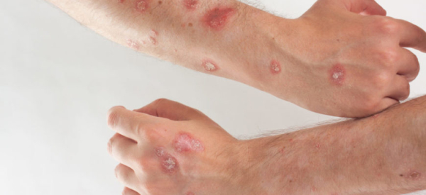 Симптомы и лечение отравлений алюминием