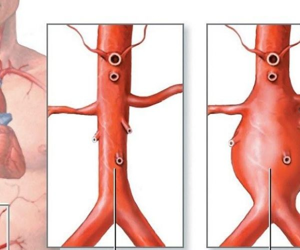 Атеросклероз отдела брюшной аорты: причины и симптомы