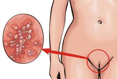ВПЧ 45 типа у женщин: что это и как лечить болезнь