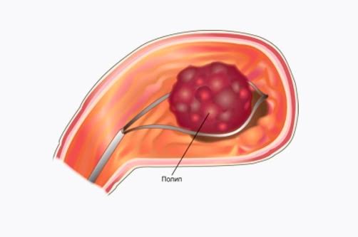 Может ли папиллома перерасти в рак?