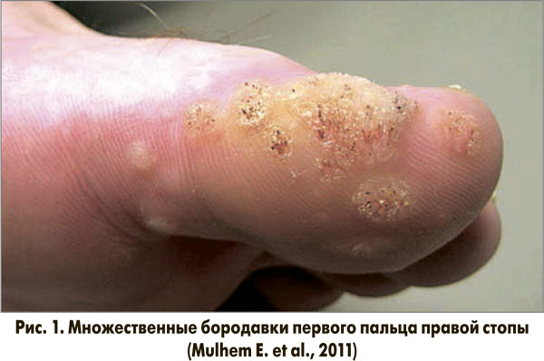 Салициловая кислота для удаления бородавок