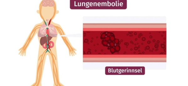 Легочная эмболия: причины, симптомы, диагностика и лечение