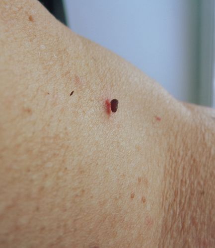 Папиллома может отвалиться сама: миф или реальность?