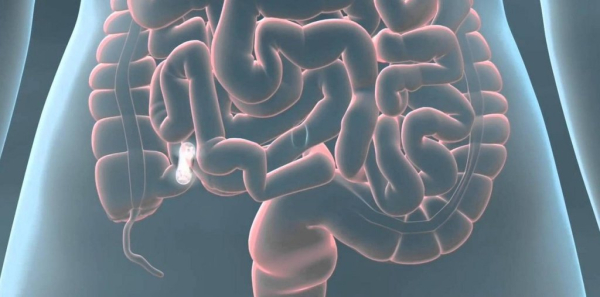 Парез кишечника: причины, симптомы, лечение, профилактика