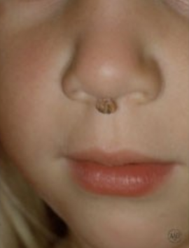 Бородавка на подбородке у ребенка