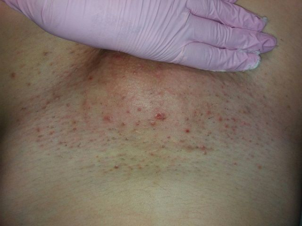 Фолликулит после депиляции: как предотвратить и чем лечить