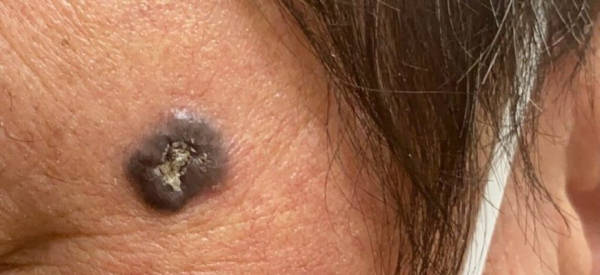 Бородавки в ухе у человека: фото, признаки, лечение