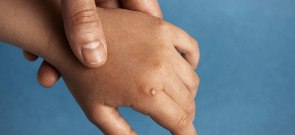 Бородавка между пальцами рук у ребенка