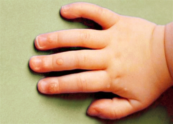 Плоские бородавки у детей: причины, симптомы и лечение