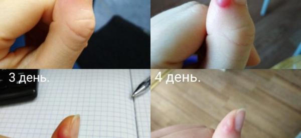 Поднялась температура после прижигания бородавки, что делать?