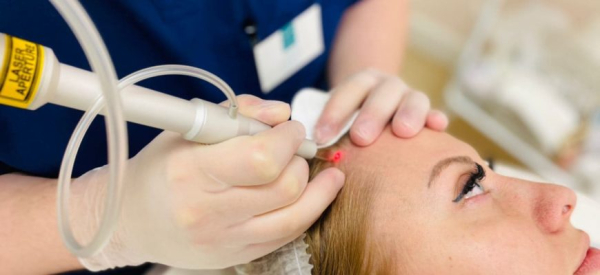 Удаление папиллом на голове в волосах