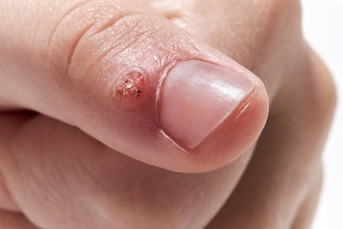 Бородавки на попе &mdash; причины, симптомы и лечение