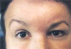 Неврит зрительного нерва: причины, симптомы, лечение