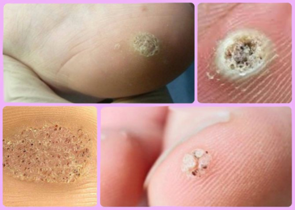 После удаления болит место удаления бородавки: что делать?