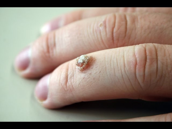 Как избавиться от бородавки на локте