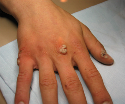 Вульгарные бородавки на лице: фото и лечение