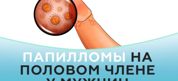 Как избавиться от папиллом на головке члена?