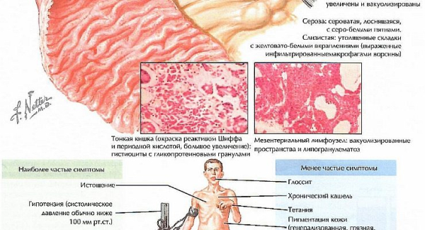Болезнь Уиппла: причины, симптомы, диагностика и лечение