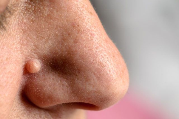 Передаются ли бородавки через рукопожатие