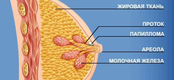 Внутрипротоковая папиллома молочной железы: симптомы и лечение