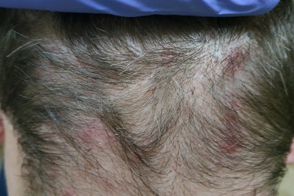 Как и чем лечить масляный фолликулит?