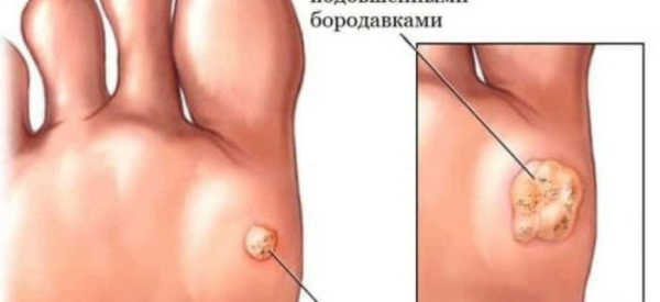 Чем отличается шипица от бородавки