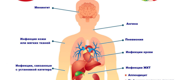 Сепсис: причины, симптомы, лечение и профилактика