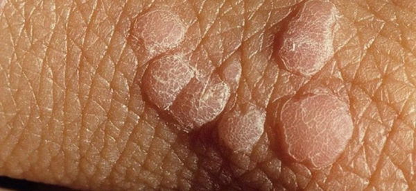 Почему чешутся бородавки на руках: основные причины