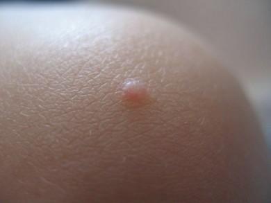 Бородавки на теле: причины появления и способы их лечения