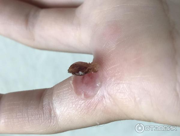 Что делать, если лопнул пузырь от бородавки