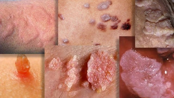 Аногенитальные бородавки: причины, симптомы и лечение