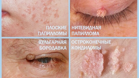 Причины и лечение папилломы у новорожденных