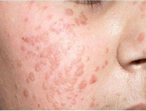 Бородавки на лбу у детей: причины появления и лечение