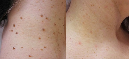 Лазерное удаление папиллом