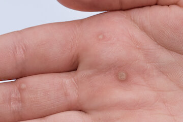 Методы лечения бородавок на плече у ребенка