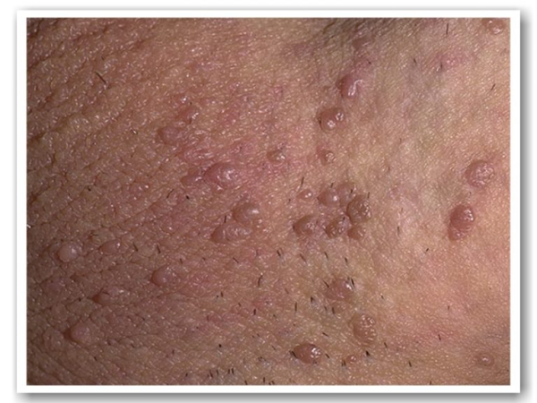 Папилломы на половых губах при беременности: симптомы и лечение