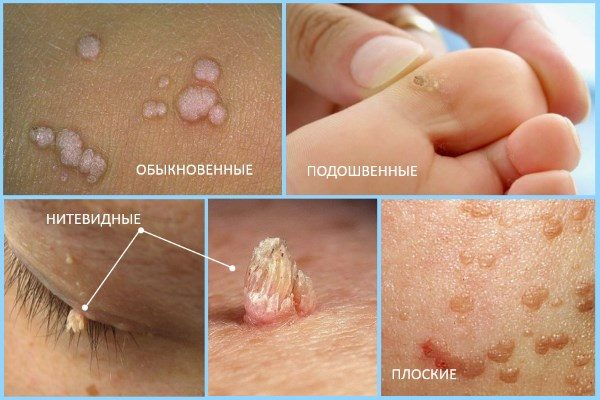 Как вывести бородавки картошкой: народные рецепты