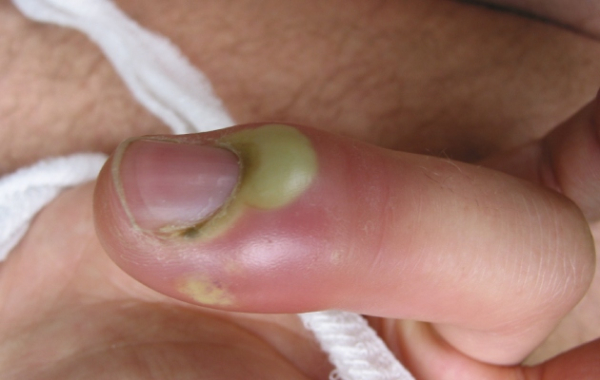 Панариций на пальце руки: причины, симптомы, лечение